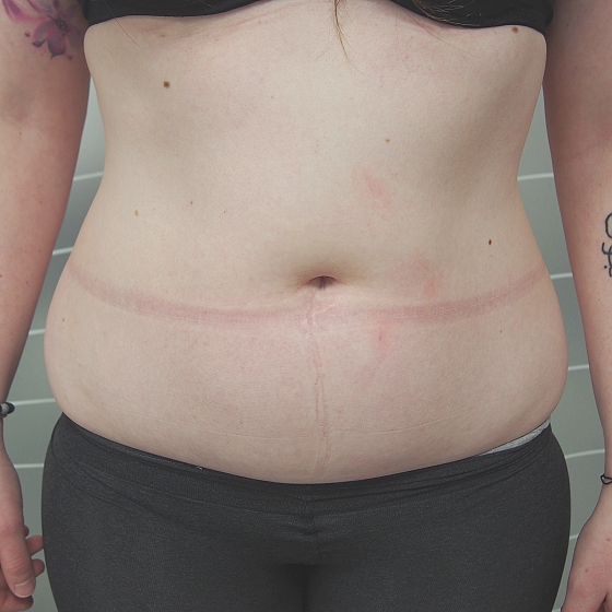 Klientka před a po neinvazivní liposukci (kryolipolýza) v oblasti břicha a boků. Klientka absolvovala 2 ošetření (úbytek 6cm tukové vrstvy v pase)