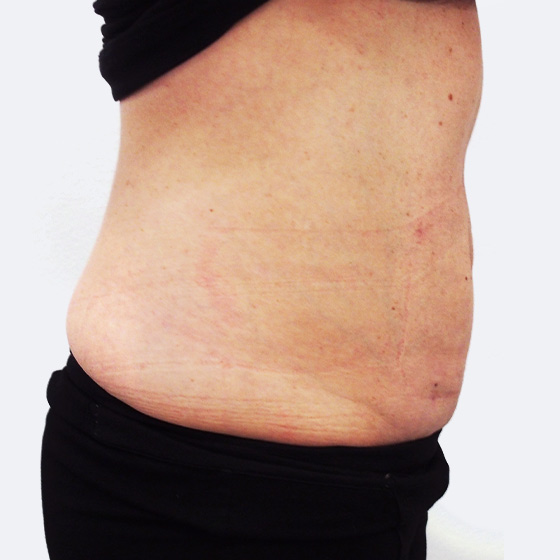 Klientka před a po liposukci břicha, foceno měsíc po zákroku.
Operatér: MUDr. Peter Ondrejka