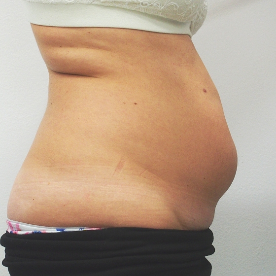 Klientka před a po ultrazvukové liposukci břicha. Odsáto 1600ml. tuku. foceno 2 měsíce po zákroku.
Operatér: MUDr. Peter Ondrejka