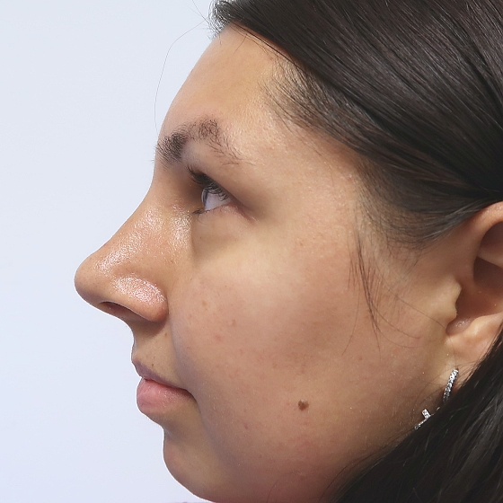 Klientka před a po plastické operaci nosu. Foceno 1,5 měsíce po zákroku.
Operatér: MUDr. Tomáš Nedeliak