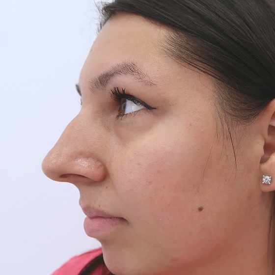 Klientka před a po plastické operaci nosu. Foceno 1,5 měsíce po zákroku.
Operatér: MUDr. Tomáš Nedeliak